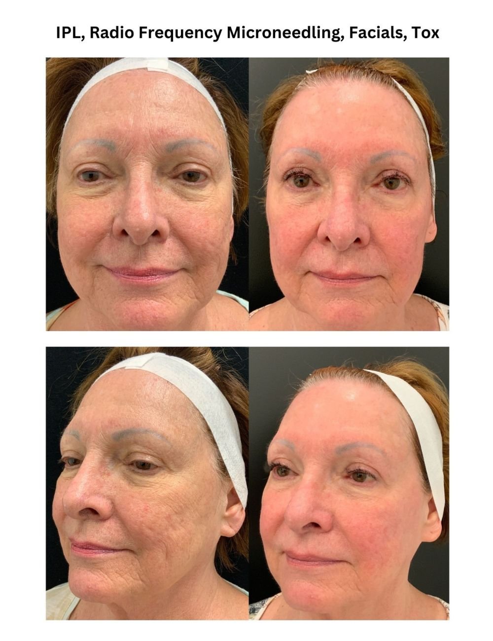 Body Contouring & Sculpting before and after