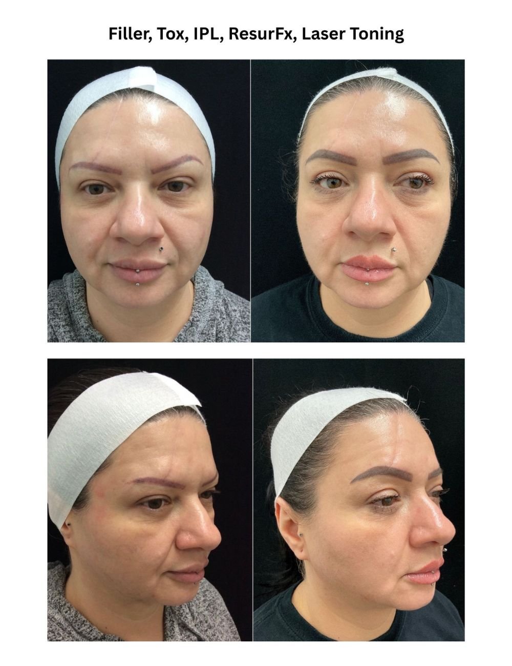 Body Contouring & Sculpting before and after