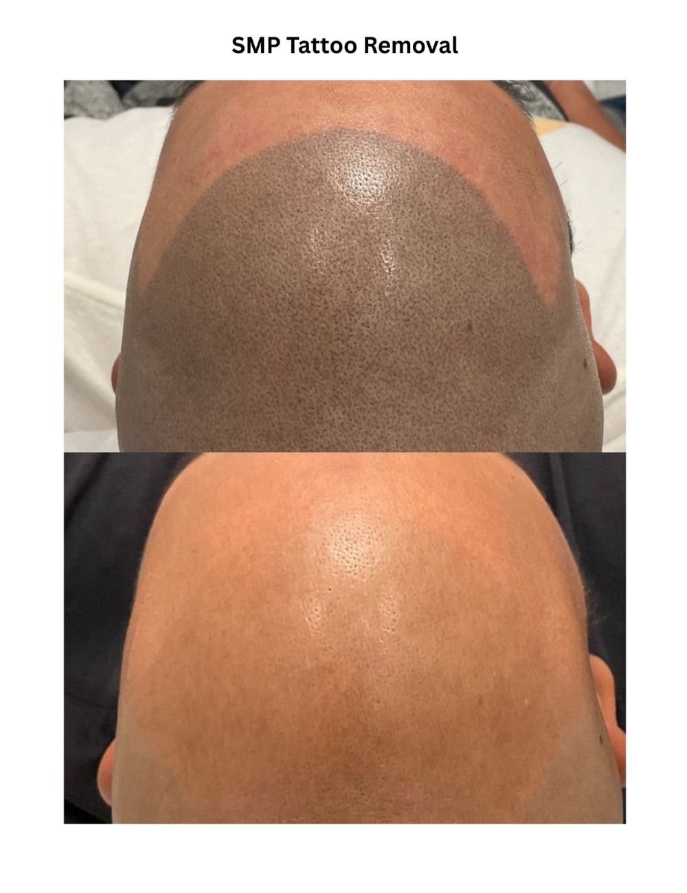 Body Contouring & Sculpting before and after