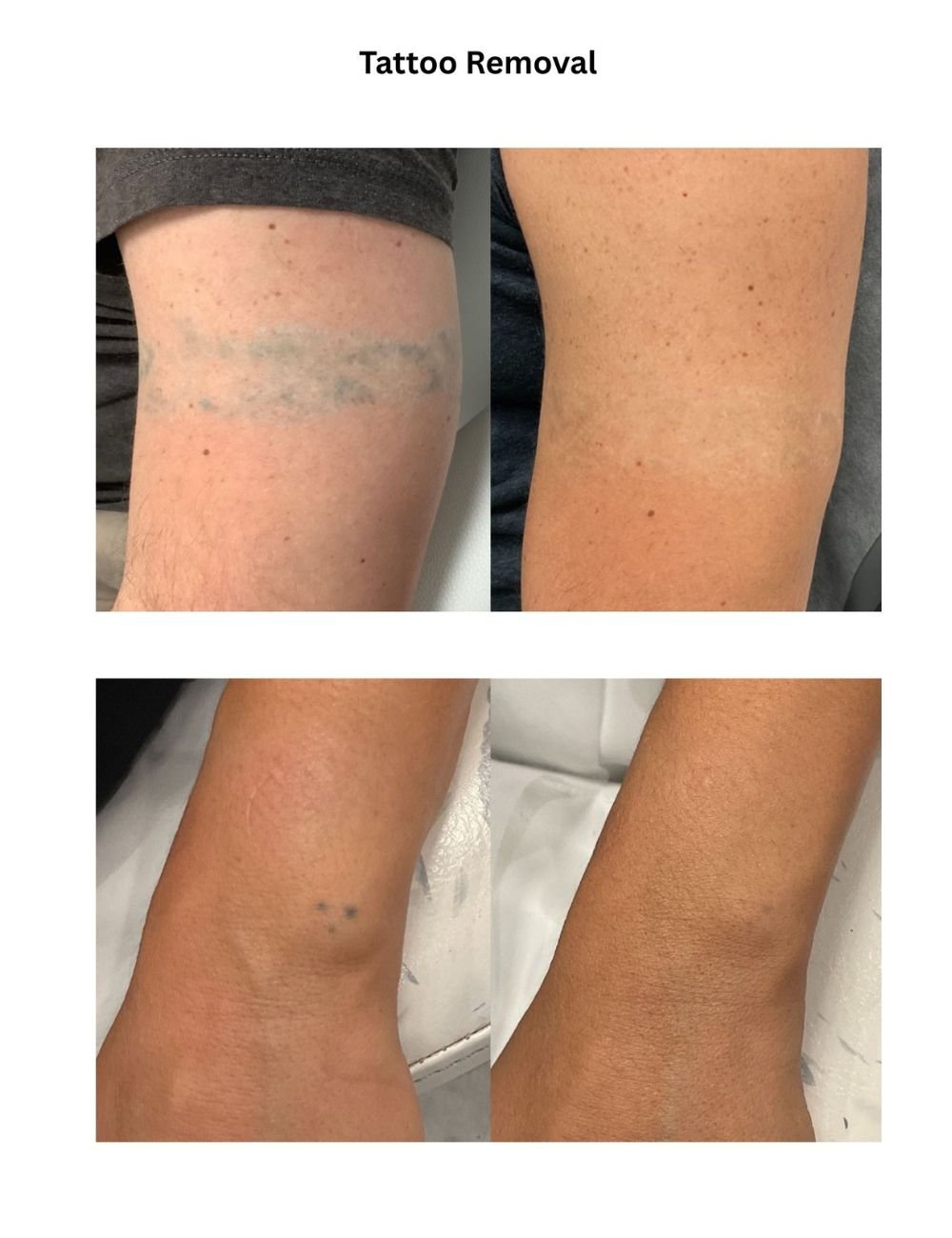 Body Contouring & Sculpting before and after