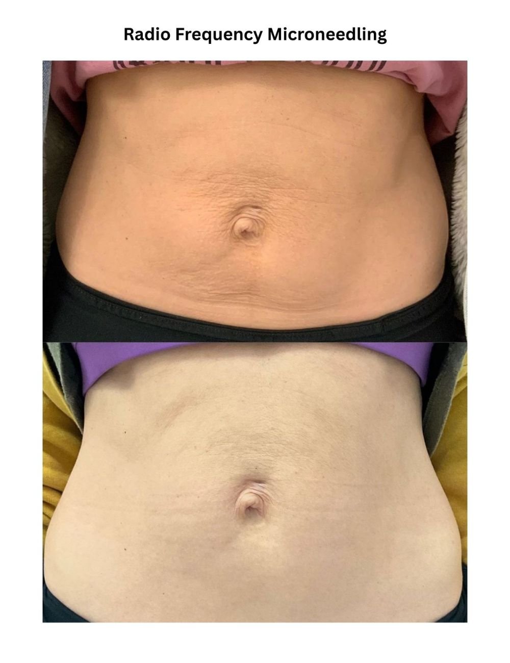 Body Contouring & Sculpting before and after