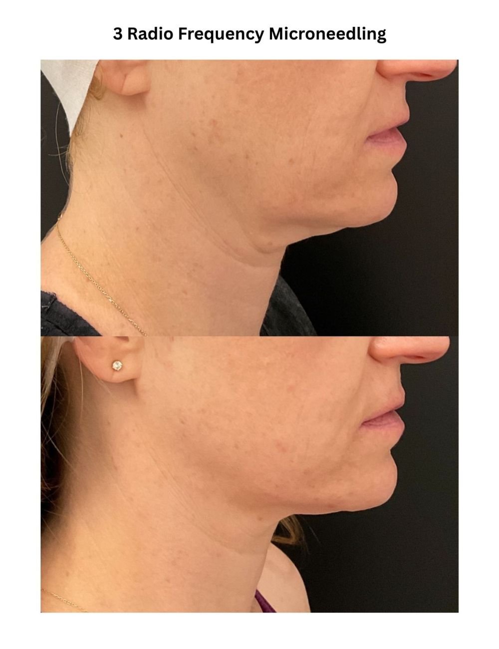 Body Contouring & Sculpting before and after