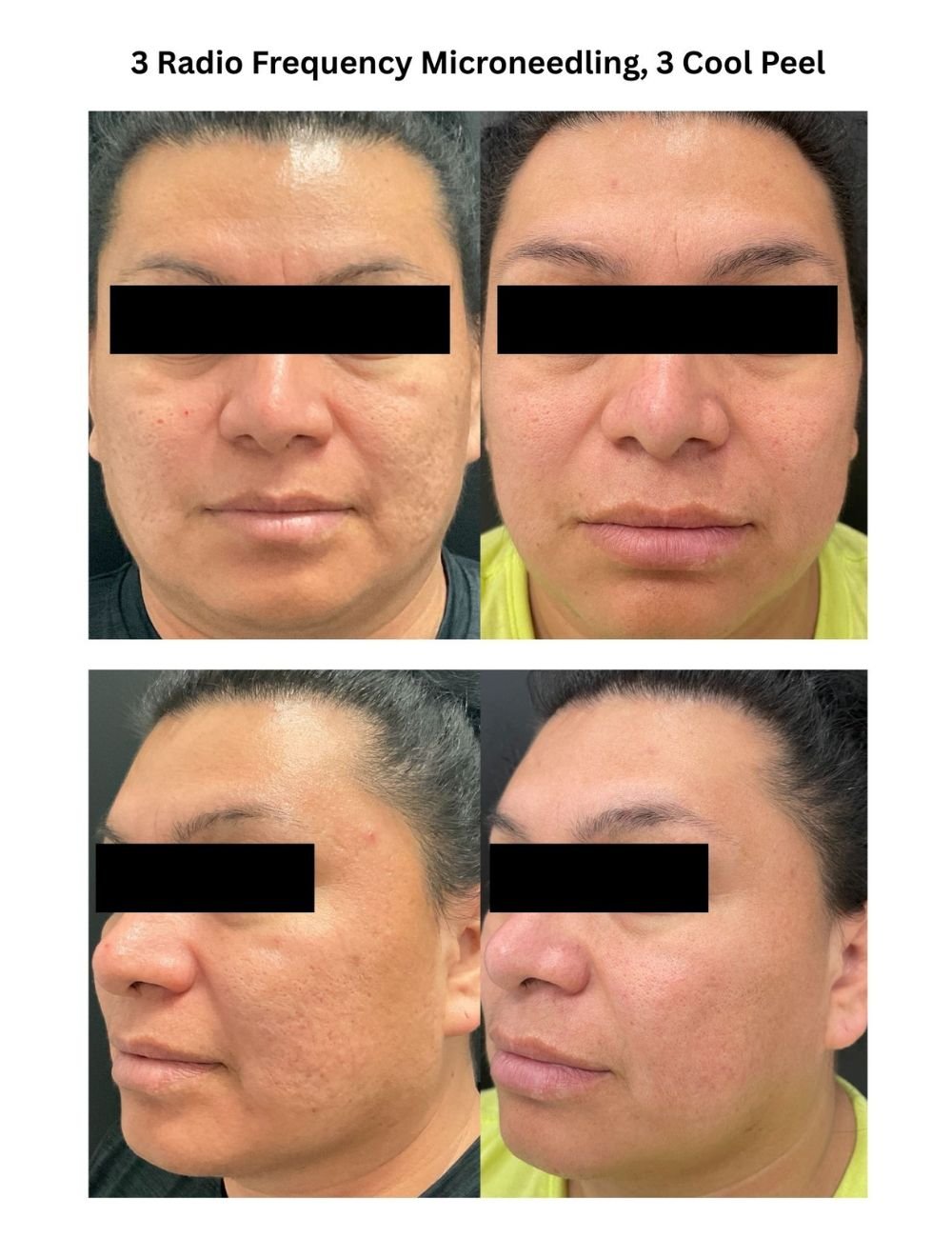 Body Contouring & Sculpting before and after