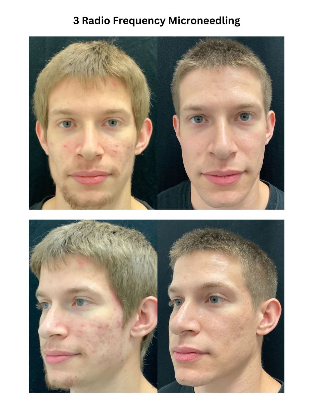 Body Contouring & Sculpting before and after