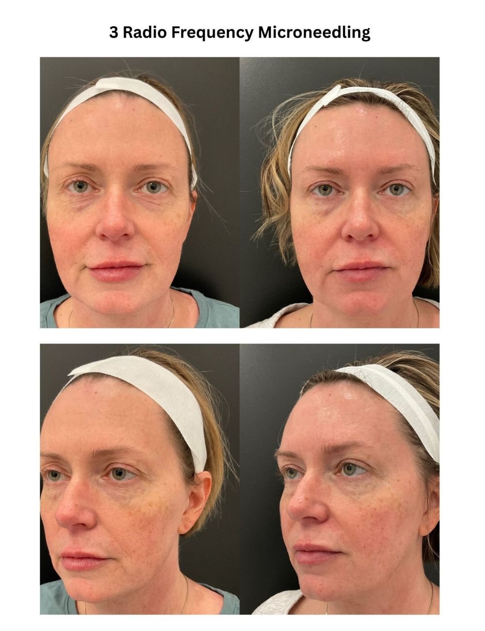 Body Contouring & Sculpting before and after