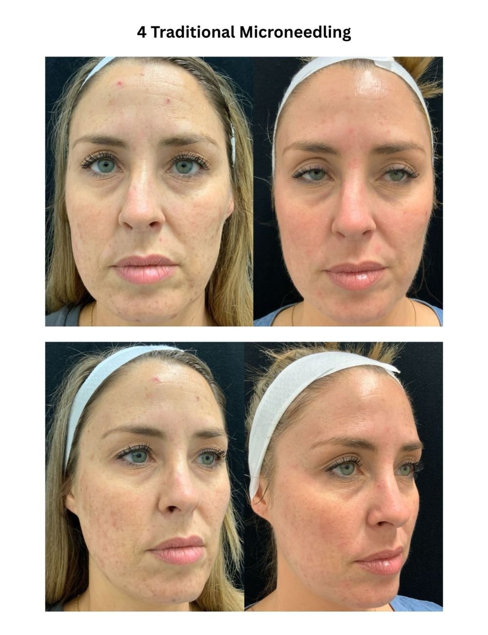 Body Contouring & Sculpting before and after