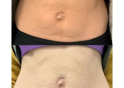 Radio Frequency Microneedling