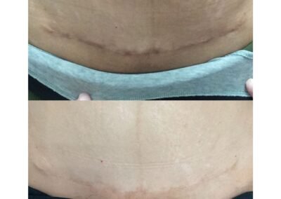 Skin Toning and RF Microneedling