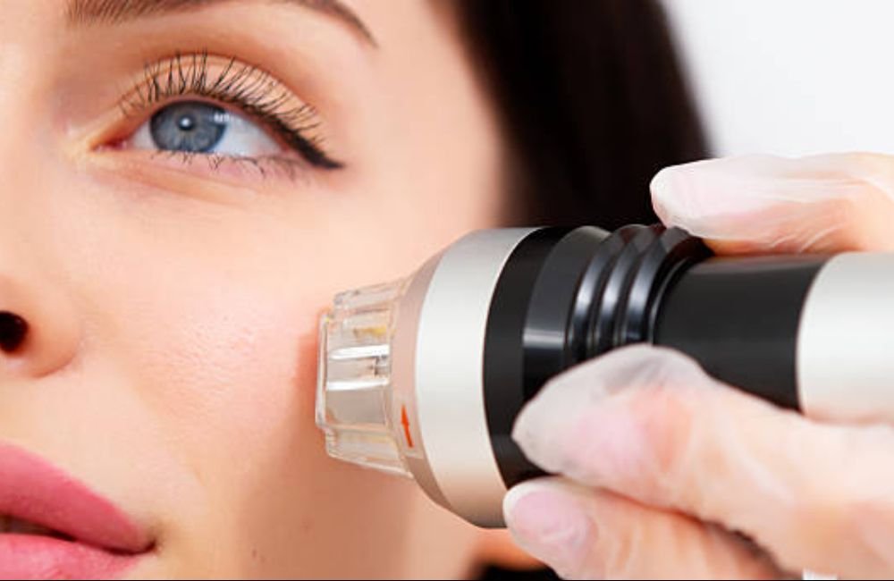 Smart RF Microneedling In East Valley, AZ