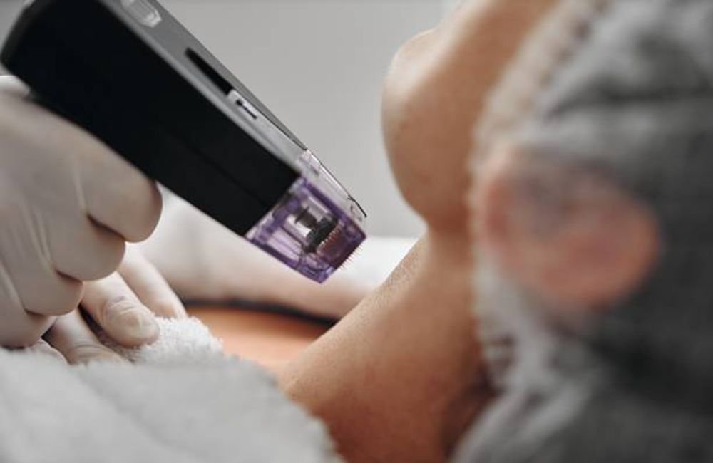 Smart RF Microneedling In East Valley, AZ