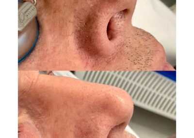 Spider Vein Reduction 4