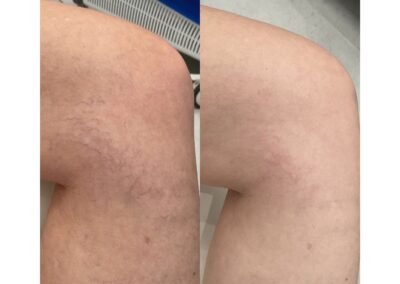 Spider Vein Reduction