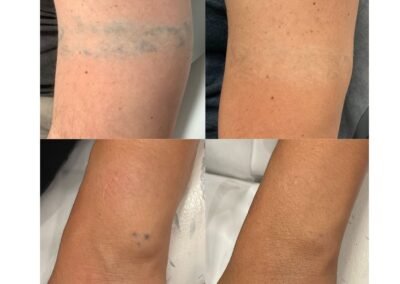 Tattoo Removal 2