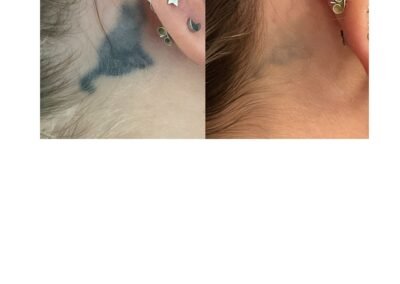 Tattoo Removal 3