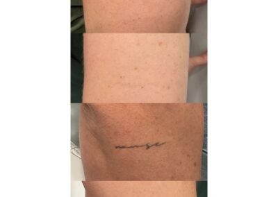 Tattoo Removal 4