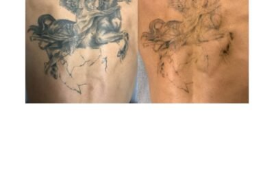 Tattoo Removal