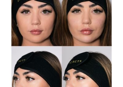 chin shadow marionettes chin jawline