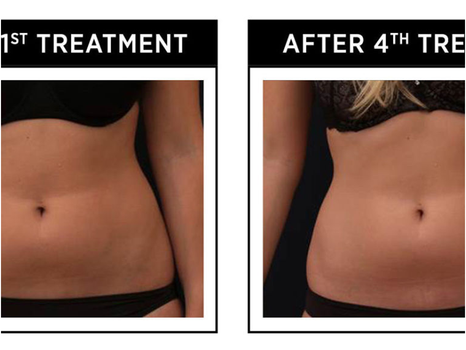 Body Contouring In Mesa, AZ