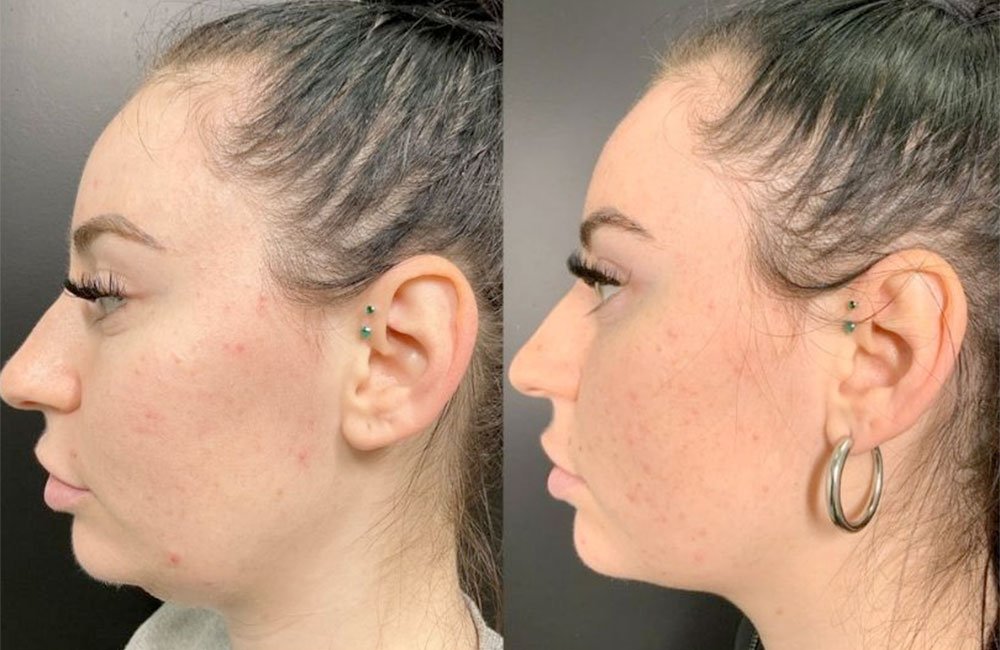 Kybella® – Lipo Dissolve