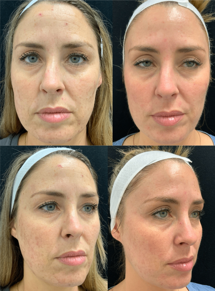 Body Contouring & Sculpting before and after