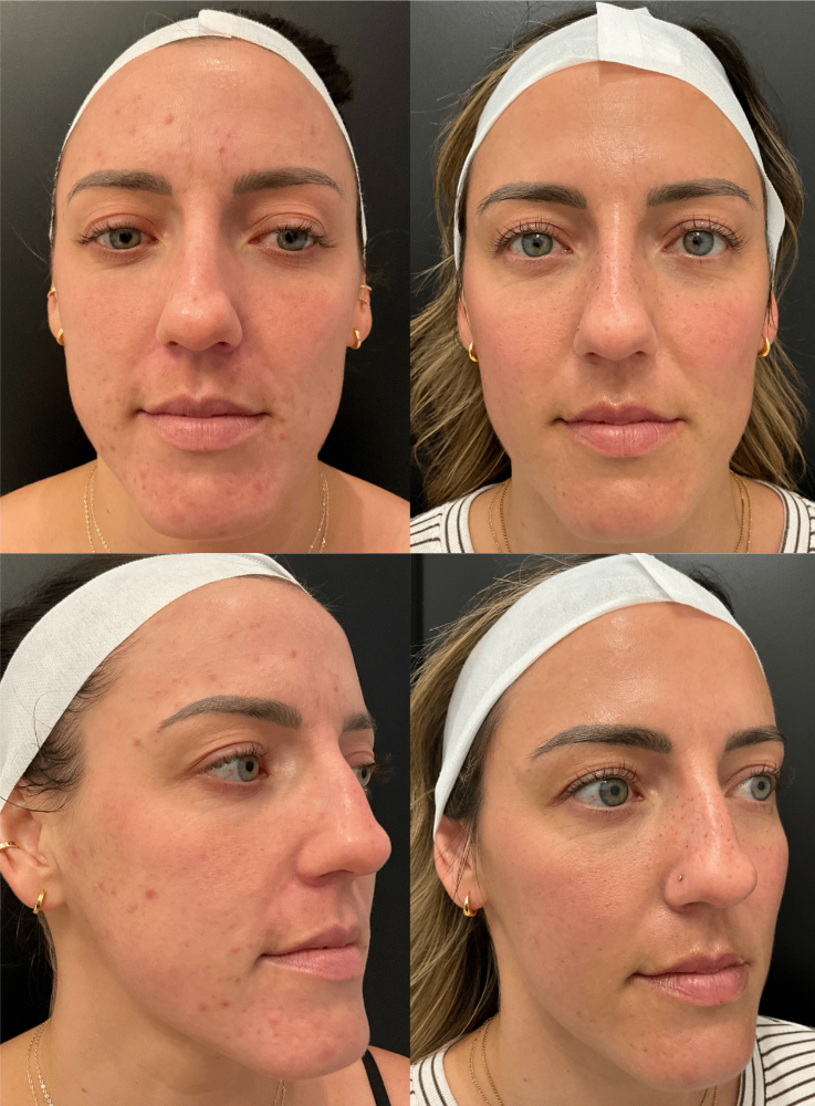 Body Contouring & Sculpting before and after