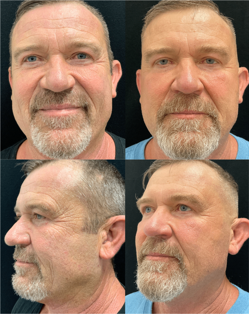 Body Contouring & Sculpting before and after