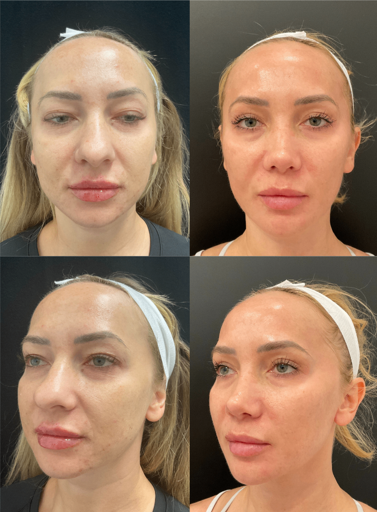 Body Contouring & Sculpting before and after