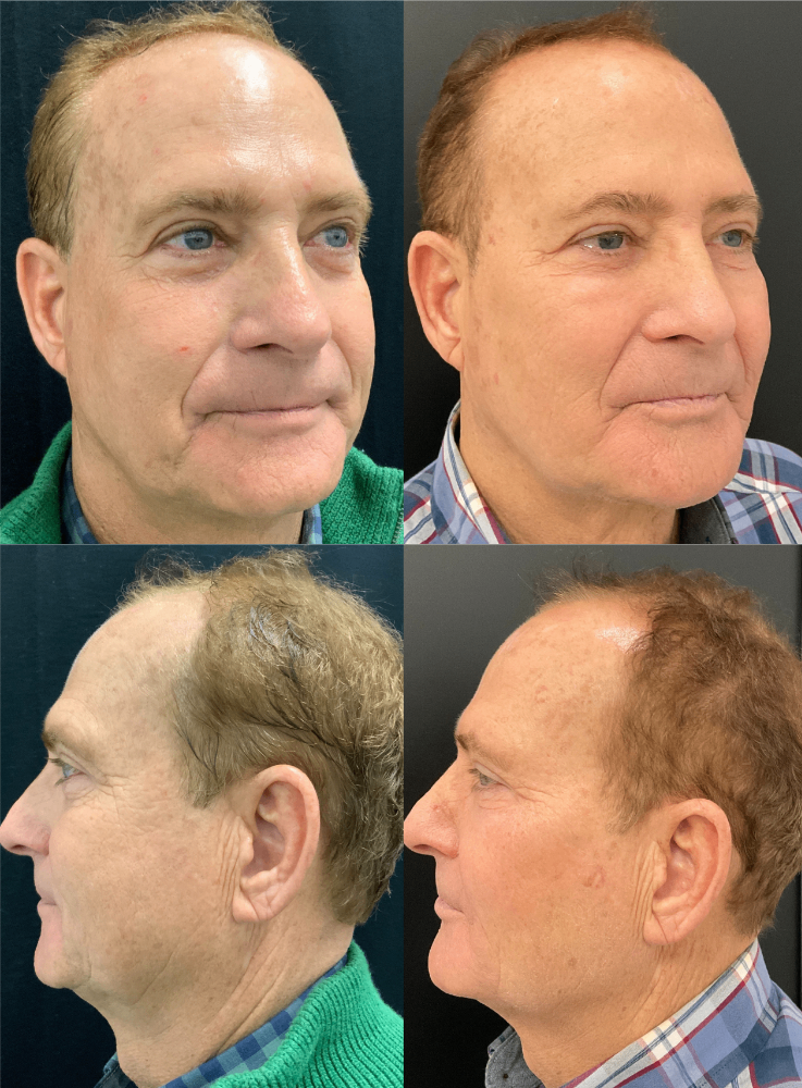 Body Contouring & Sculpting before and after