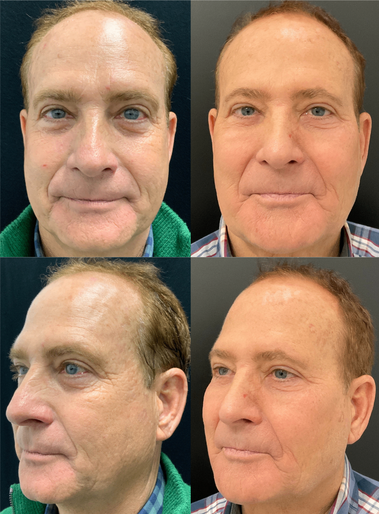 Body Contouring & Sculpting before and after