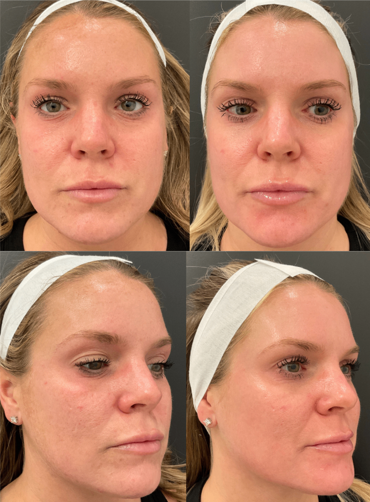 Body Contouring & Sculpting before and after