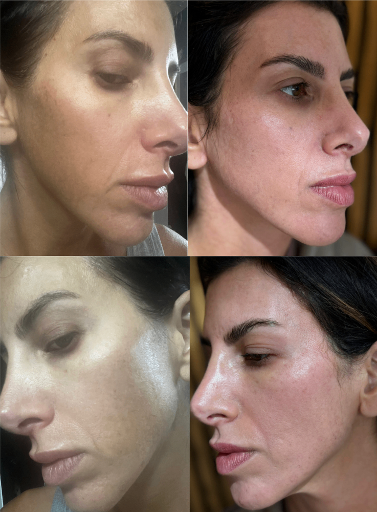 Body Contouring & Sculpting before and after