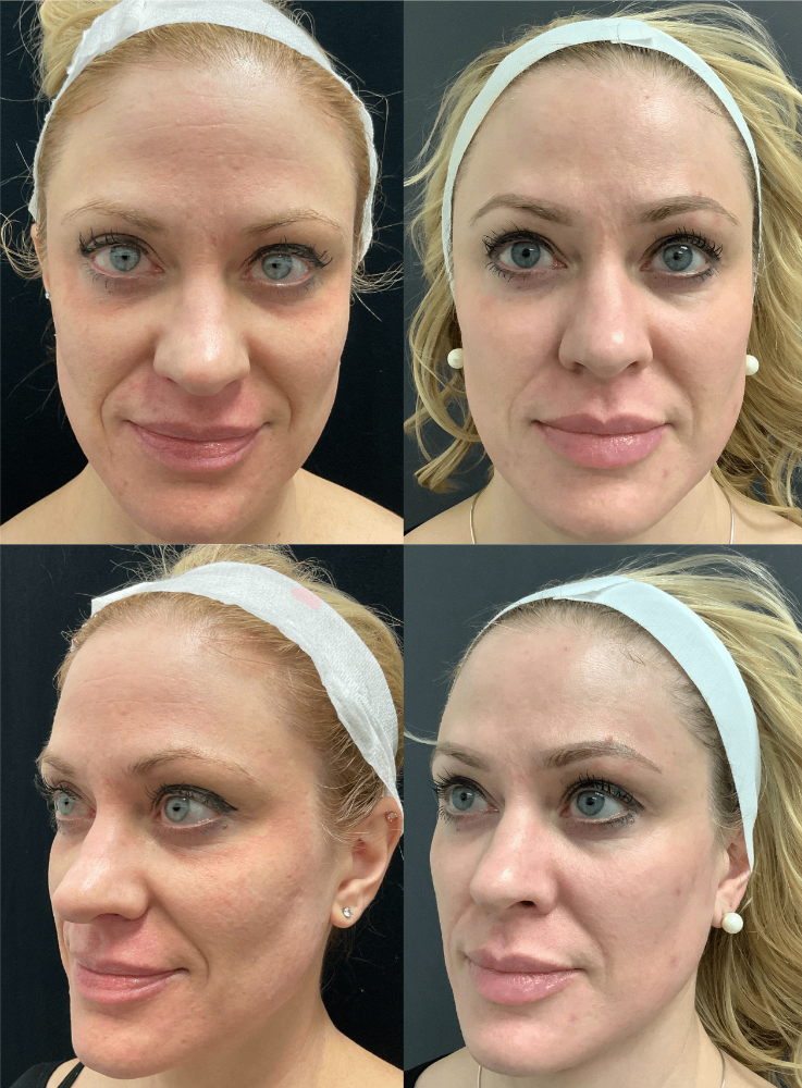 Body Contouring & Sculpting before and after