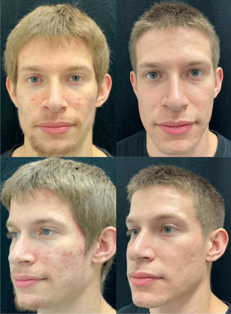 Body Contouring & Sculpting before and after