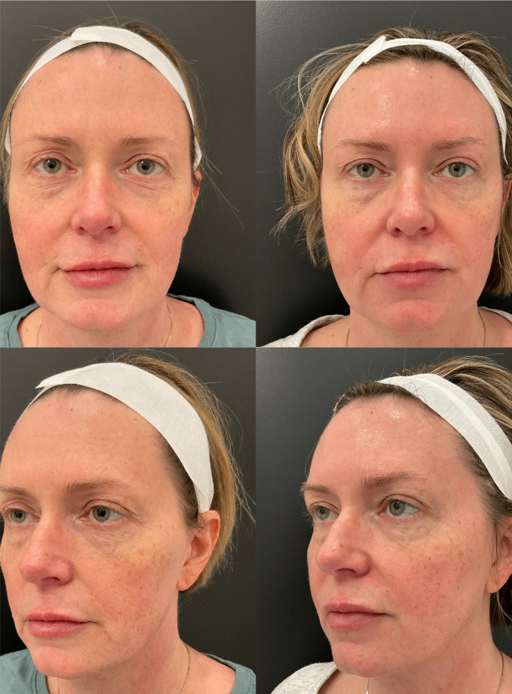 Body Contouring & Sculpting before and after