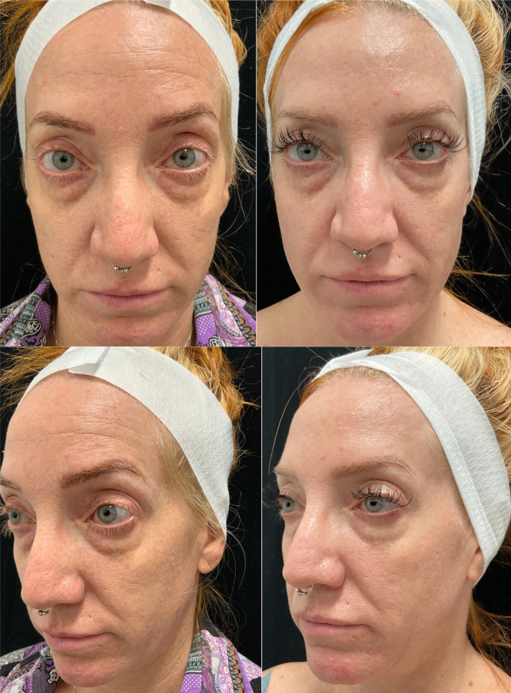 Body Contouring & Sculpting before and after