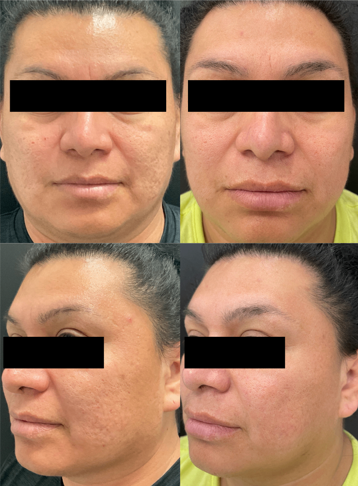 Body Contouring & Sculpting before and after