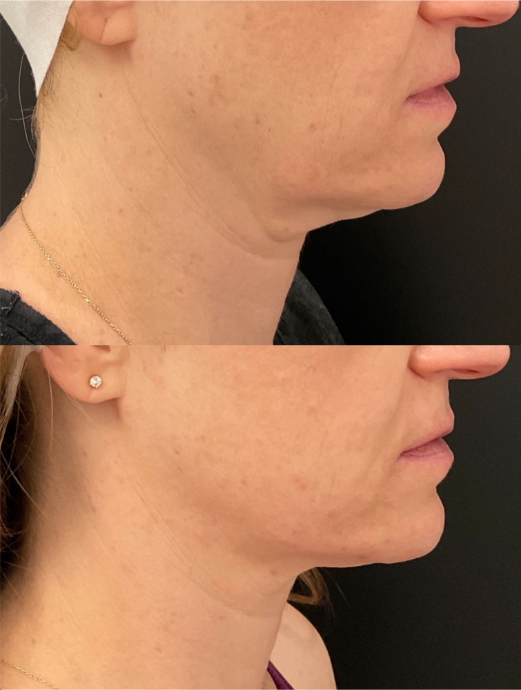 Body Contouring & Sculpting before and after